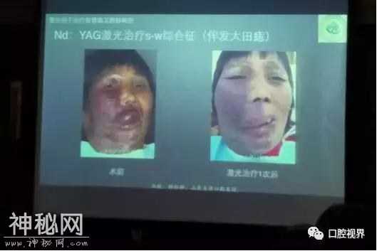 激光在口腔应用中的“灵异事件”《激光在口腔医学的应用学习班》-3.jpg