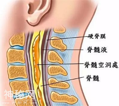 怪病！四肢麻木、不知冷热，可能是脊髓空洞症-1.jpg