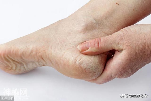 脚部出现5种现象，多是暗示体内有病变，请你不要大意-3.jpg