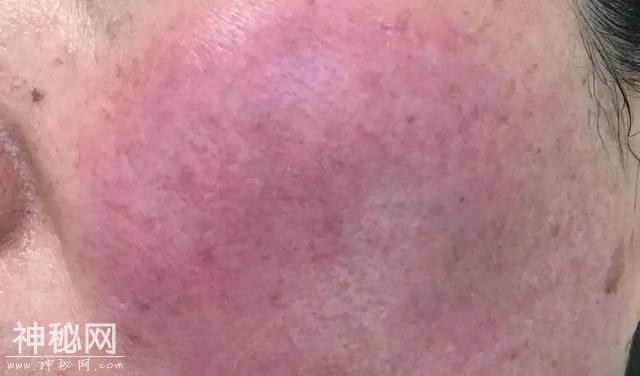 戴口罩还化妆，她的脸烂了！医生做了一个细菌实验，结果惊人！-4.jpg