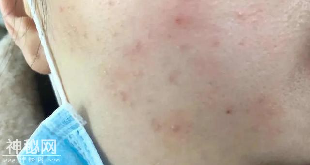 戴口罩还化妆，她的脸烂了！医生做了一个细菌实验，结果惊人！-2.jpg