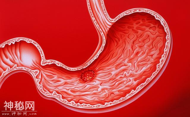 体内有幽门螺杆菌，身体往往有五个标志，超过3个，及时排查胃癌-1.jpg