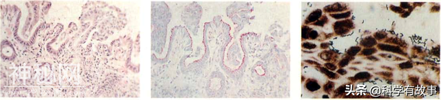 10亿细菌一口闷：马歇尔和幽门螺旋杆菌的不解之缘-6.jpg