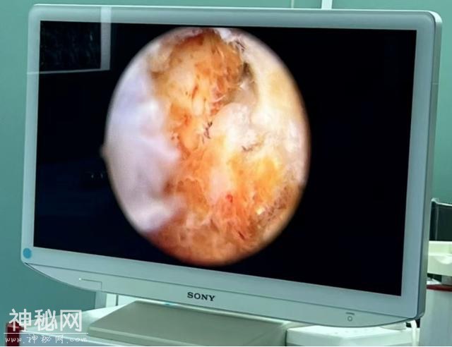 这是什么怪病？有人体内长出大量绒毛，犹如螃蟹脚！专盯这类人群-5.jpg