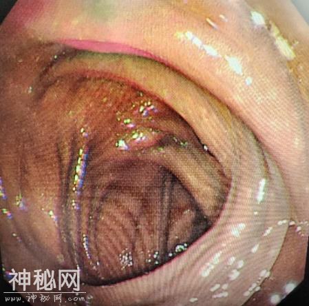 35岁女子突患怪病，一查竟是“砒霜”中毒！-8.jpg