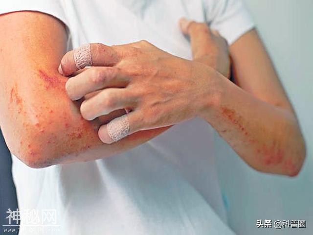人体诡异的器官：皮肤为什么会莫名“发痒”？科学家至今无法解释-11.jpg